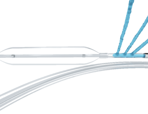 L’Innovation en angioplastie : le Dispositif All-inCath 035M par le Dr Sarradon