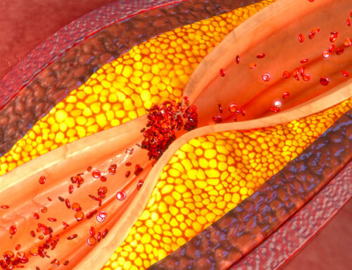 Prévention de l’athérosclérose : comment protéger vos artères