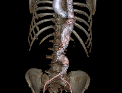 Anévrismes aortiques thoraco-abdominaux : causes, symptômes et traitements 